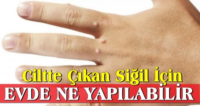 Ciltte Çıkan Siğil İçin Evde Ne Yapılabilir